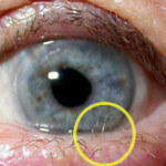 trichiasis1c