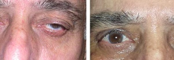 Three Reasons Not to Put Off Treatment for Ptosis