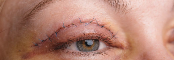 Heavy Eyelid Surgery Might Be Covered by Insurance