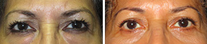 upper-eyelid-blepharoplasty